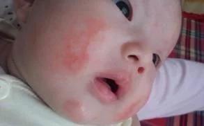 月嫂怎样解决宝宝湿疹问题,月子孩子起湿疹月嫂有责任吗