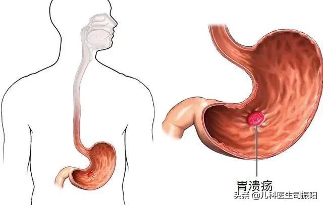 儿童幽门螺旋杆菌会传染给大人吗,儿童幽门螺旋杆菌吃益生菌管用吗