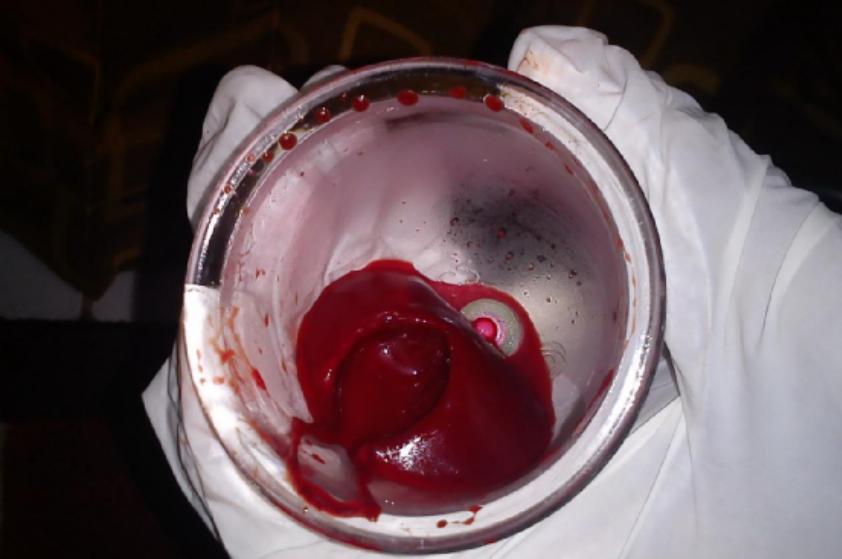 水蛭,从古到今它都是医生的帮手......