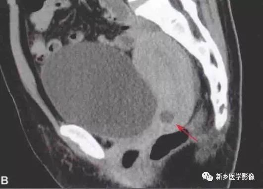 宫颈纳氏囊肿严重吗,宫颈纳氏囊肿