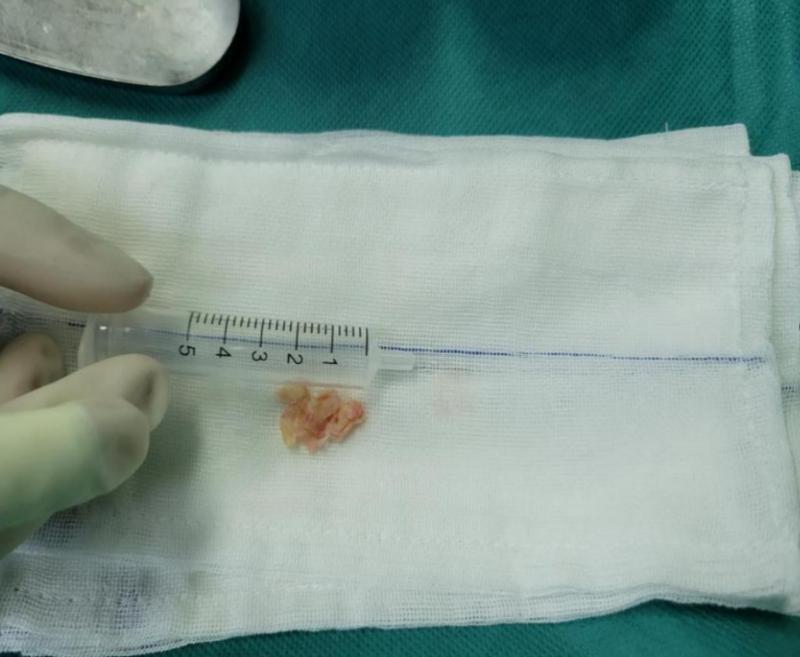 腰椎微创手术不做纤维环缝合,不开刀微创腰椎手术怎么做