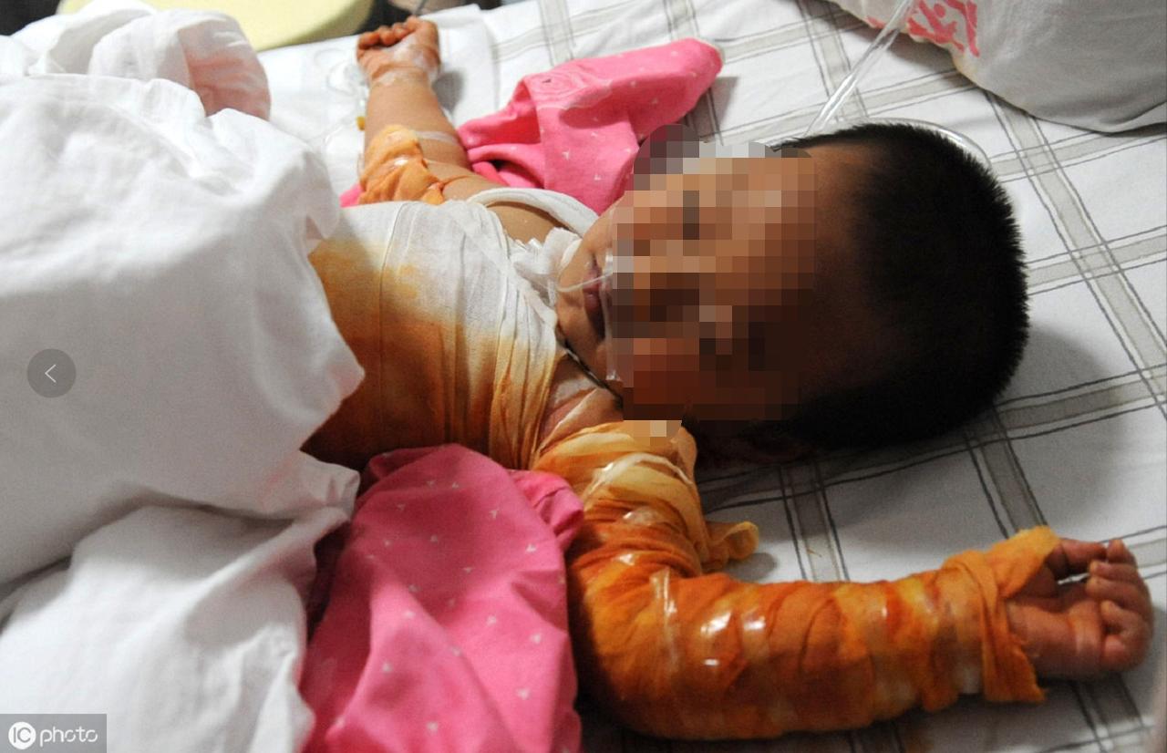 烫伤小孩送医院,4岁小孩烫伤被送进icu
