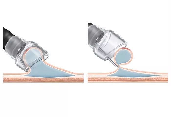 emr和esd消化内镜哪个好,内镜下esd和emr治疗的区别