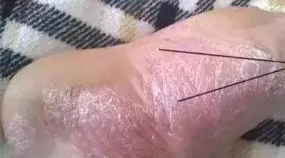 有脚气穿鞋子怎么消毒,为什么穿凉鞋也会有脚气