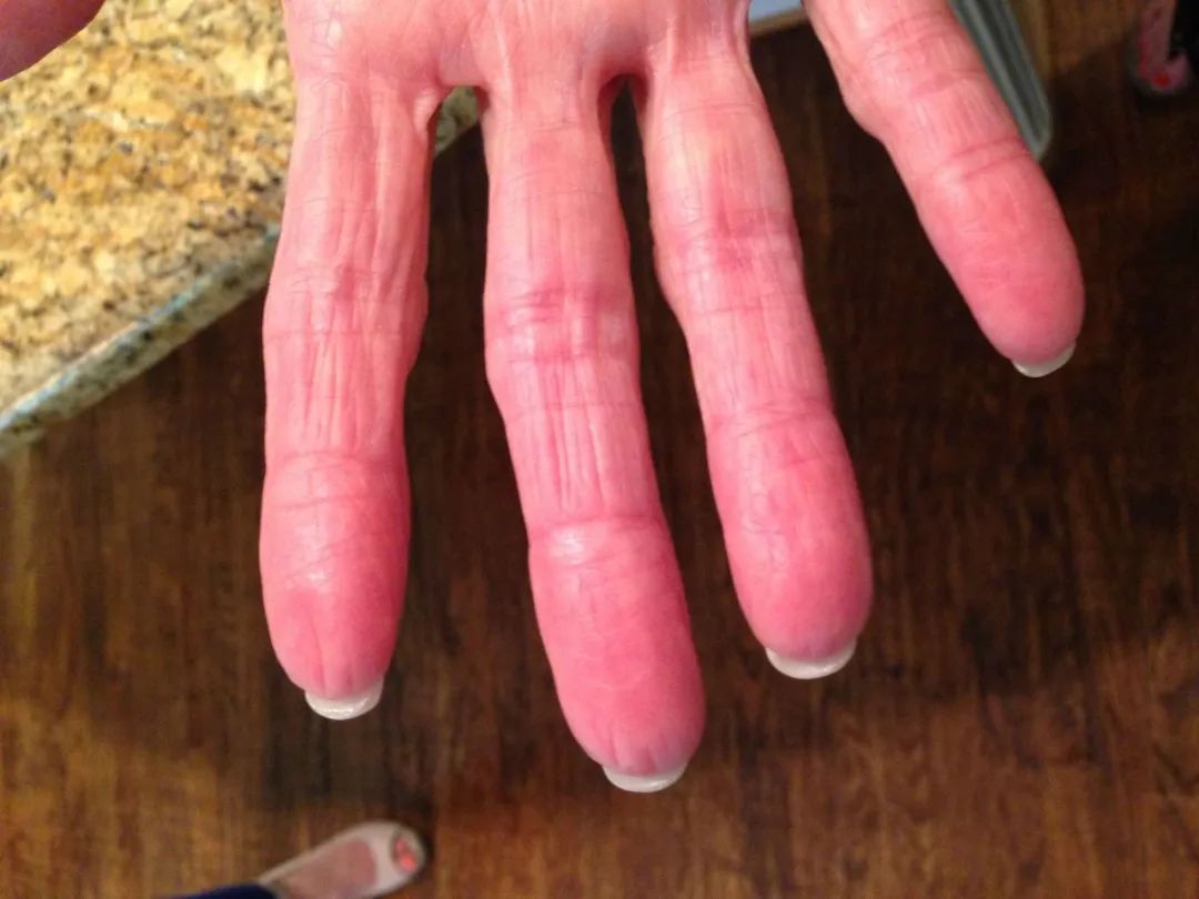 有哪些无指纹的人,没有指纹的人有什么缺点