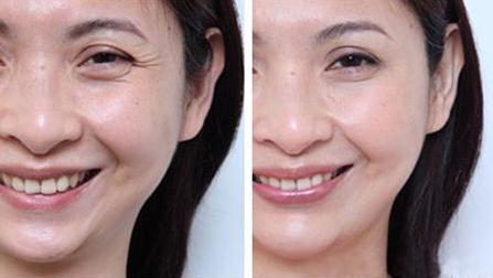 淡化眼纹黑眼圈的方法,女人眼睛看起来很显老要怎样调理