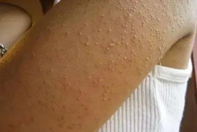 鸡皮肤怎么消除最彻底方法,额头鸡皮肤怎么消除最有效