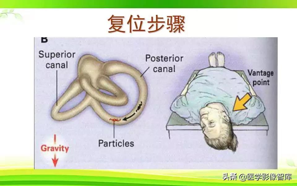 容易被误诊为耳石症的疾病,耳石症眩晕怎么确诊