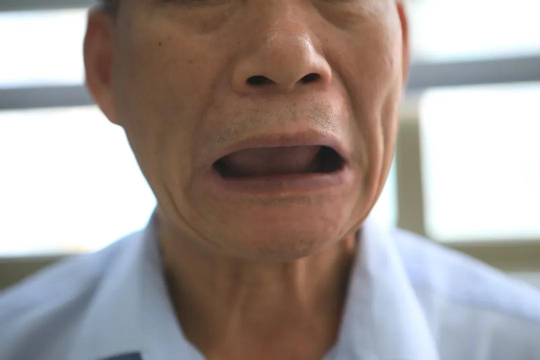 奥齿泰种植牙5年后真实感受,种牙花了好几万