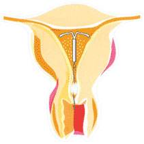 曼月乐环是怎么消炎的,曼月乐环是怎么放进去的