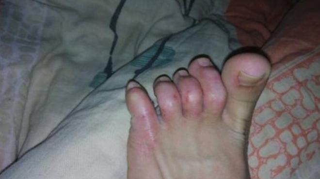 下身有几只阴虱怎么办,内裤上出现虱子卵怎么办