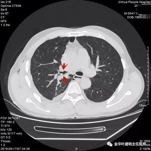 省级医院也漏诊?还好没耽误病情!我们予以行右中下叶袖式切除术