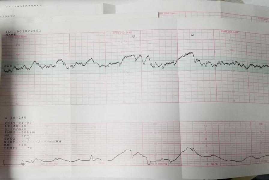 孕晚期突发腹痛:当心卵巢肿瘤扭转