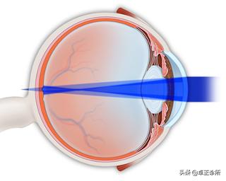 小孩眼睛近视散光怎么改善,眼睛散光近视要怎么改善