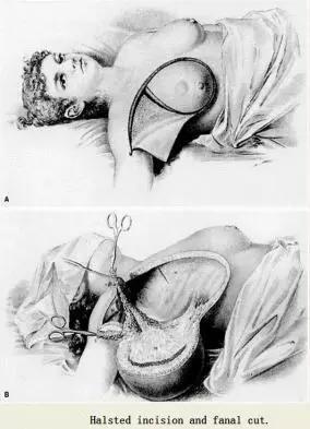 乳腺癌乳房破溃治疗步骤,乳房里肿块怎么动手术