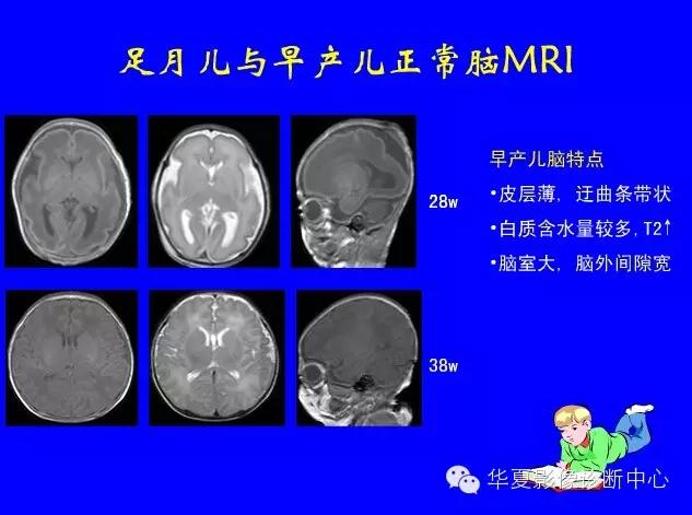 新生儿颅脑mri,新生儿颅脑mr报告模板