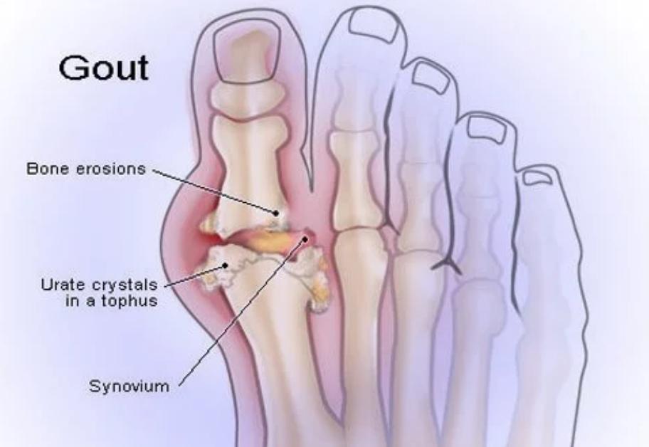 痛风发作关节痛如何缓解,痛风疼痛难忍痛风反复发作怎么办
