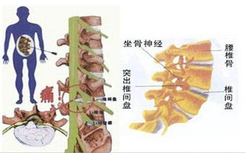 腰椎间盘突出症，正因为难治，故而一直被所谓的专家权威所误导