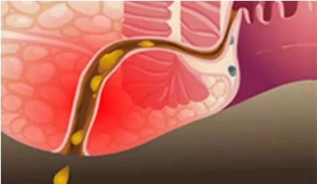 北京广安门中医院治肛瘘方法,肛瘘北京肛肠医院