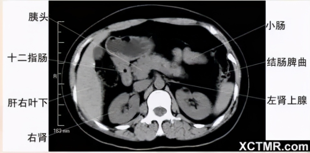 女性盆腔ct断层解剖结构图,女性盆腔脏器ct解剖