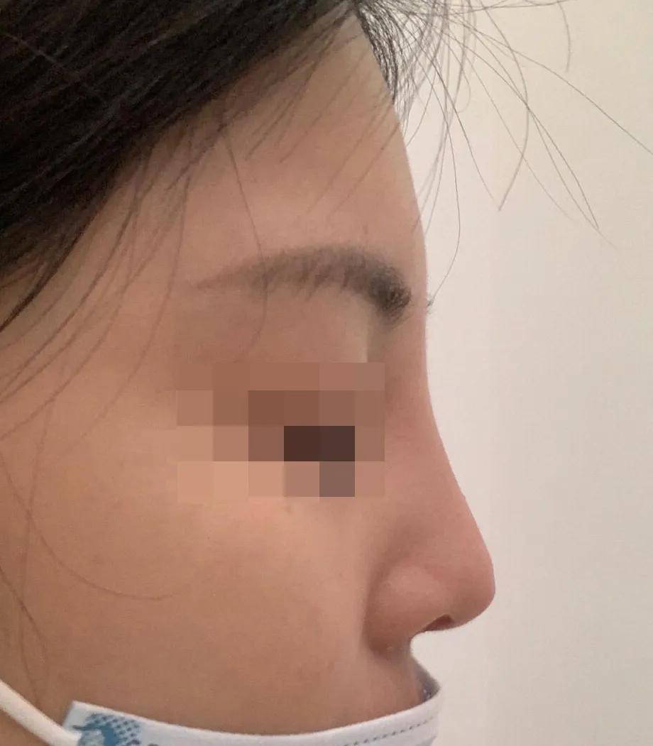 鼻部不立体,鼻部垫高