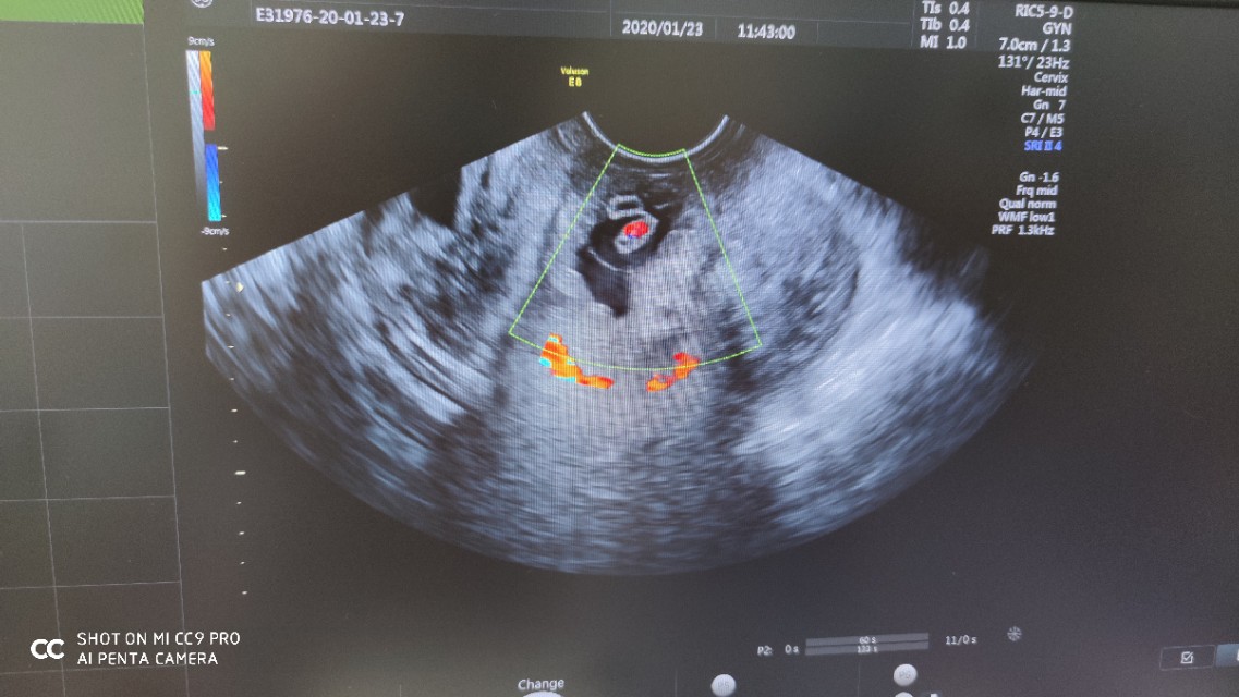 跑偏了的受精卵，竟化身为一颗夺命*弹炸**！