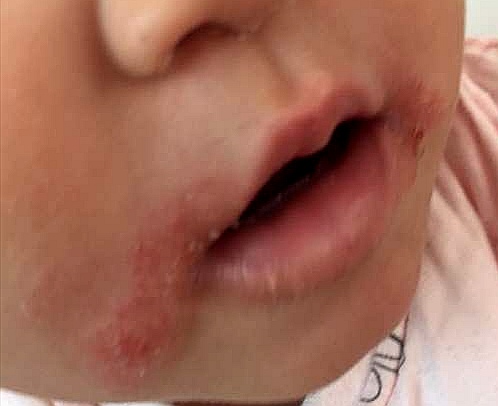 过敏原检测有没有用,过敏原检测麻烦吗