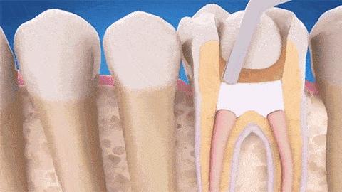 牙齿松动最佳补救方法种牙,牙齿松动怎么保护