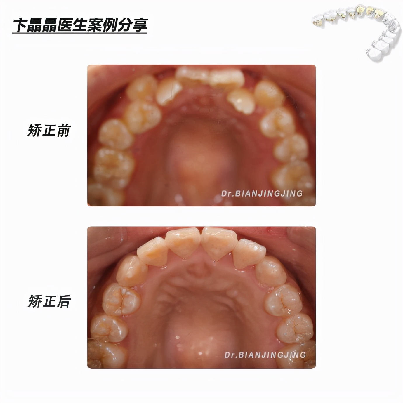 沈阳矫正牙齿大概多久能矫正过来,沈阳牙齿代偿矫正哪里好