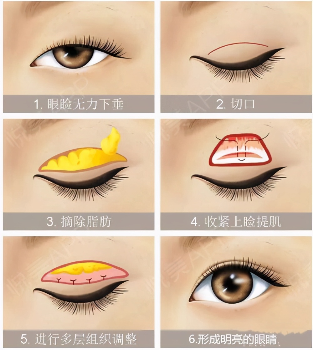 女子双眼皮术后大小眼,大小眼做了双眼皮感觉眼角不对称