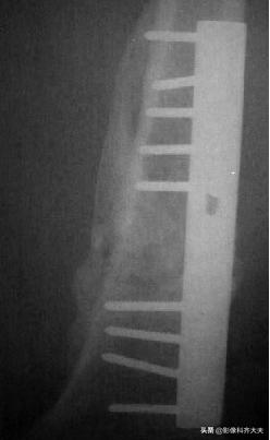 骨折的影像学检查及各自的优势,骨折的影像学愈合标准