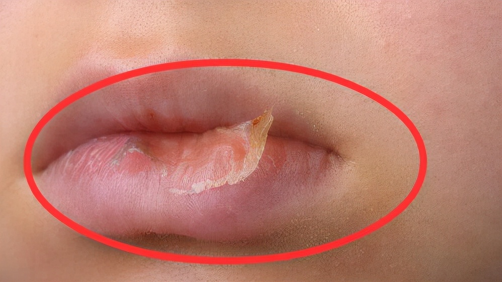 小孩长期嘴唇干裂起皮还出血,儿童嘴唇起皮干裂出血怎么办