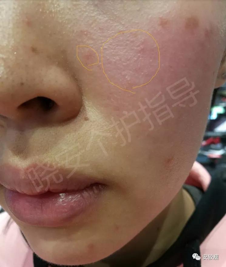 皮炎疹子干燥泛红,秋冬皮肤泛红发烫