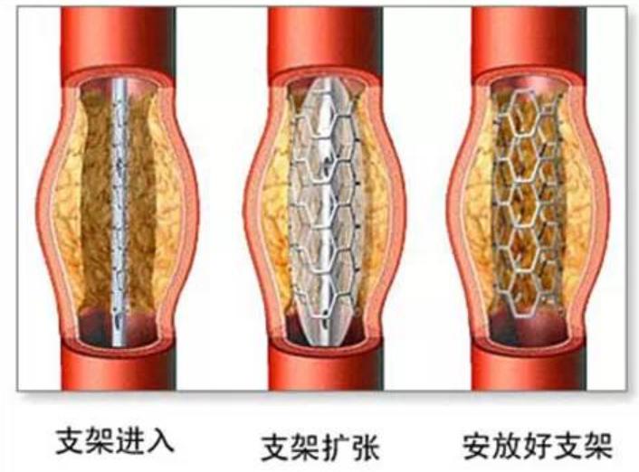 冠心病突发周围人如何急救,有冠心病的人平常表现