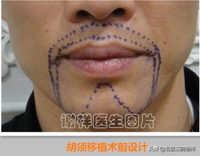 胡子种植可行吗需要注意哪些问题,胡子种植有什么讲究