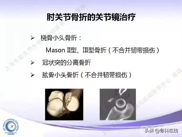 肘关节镜手术后引流,肘关节镜微创手术