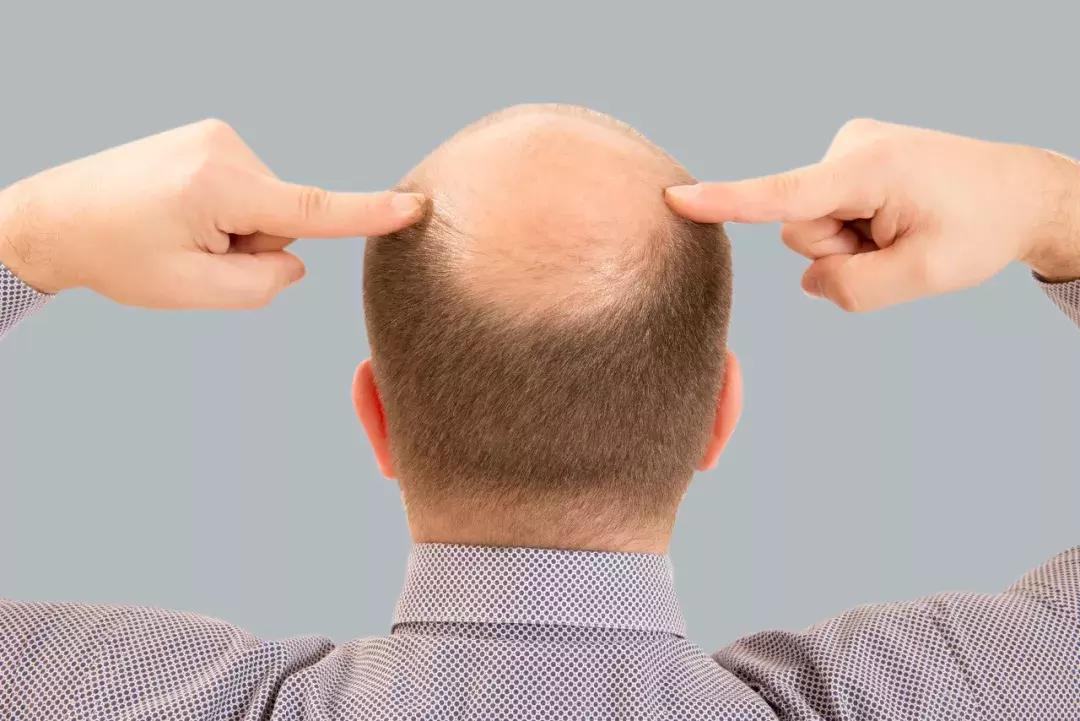 史云逊植发3000毛囊要多少钱,碧莲盛植发3000毛囊要多少钱