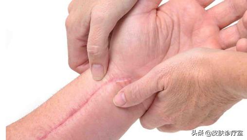 怎么祛疤无成本,怎么祛疤呢