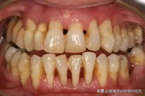 牙龈萎缩露出牙根怎么刷牙,牙龈萎缩的厉害露出牙根怎么补救