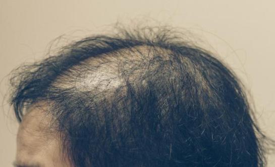 南昌第12医院植发靠谱吗,南昌植发机构的毛囊从哪来