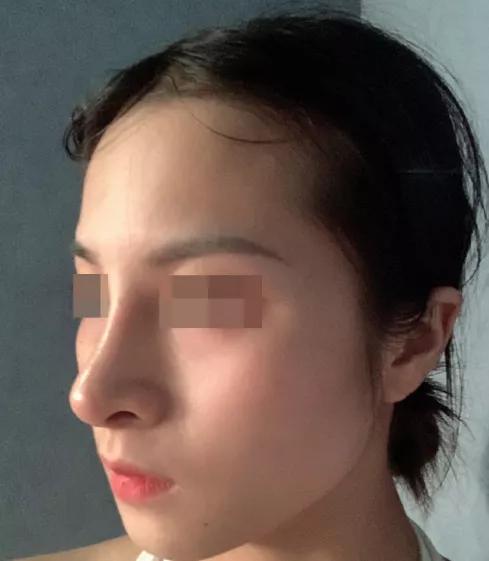 假体隆鼻太突兀了,韦敏鼻子修复视频