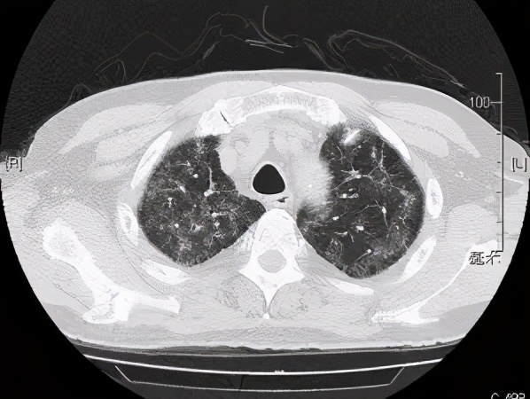 阵发性房颤和用药有关系吗,房颤药物控制好了还会复发吗