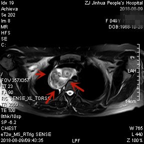 甲状腺肿瘤超大,胸骨后甲状腺肿病情是否很严重