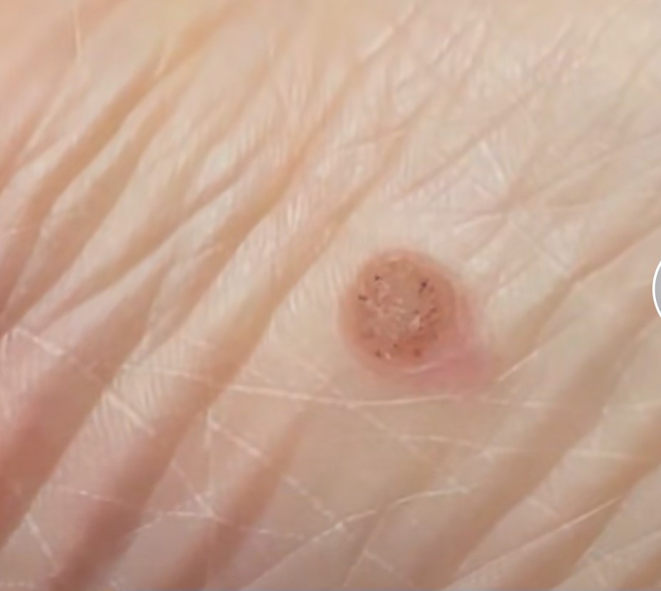 液氮冷冻怎么去除增厚的皮肤,液氮冷冻手指表皮变薄