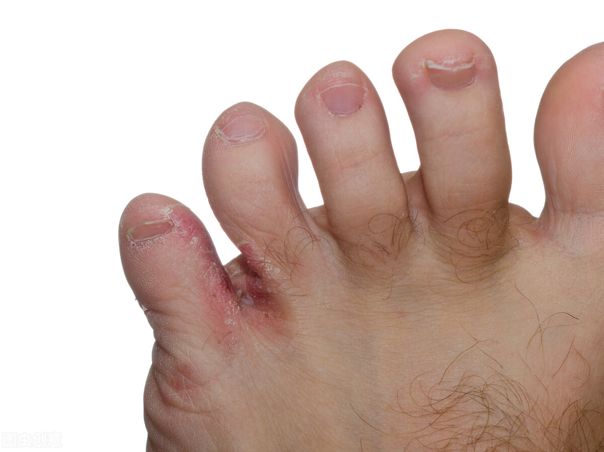 脚气足癣怎么治疗最有效,香港中医治疗脚气的偏方