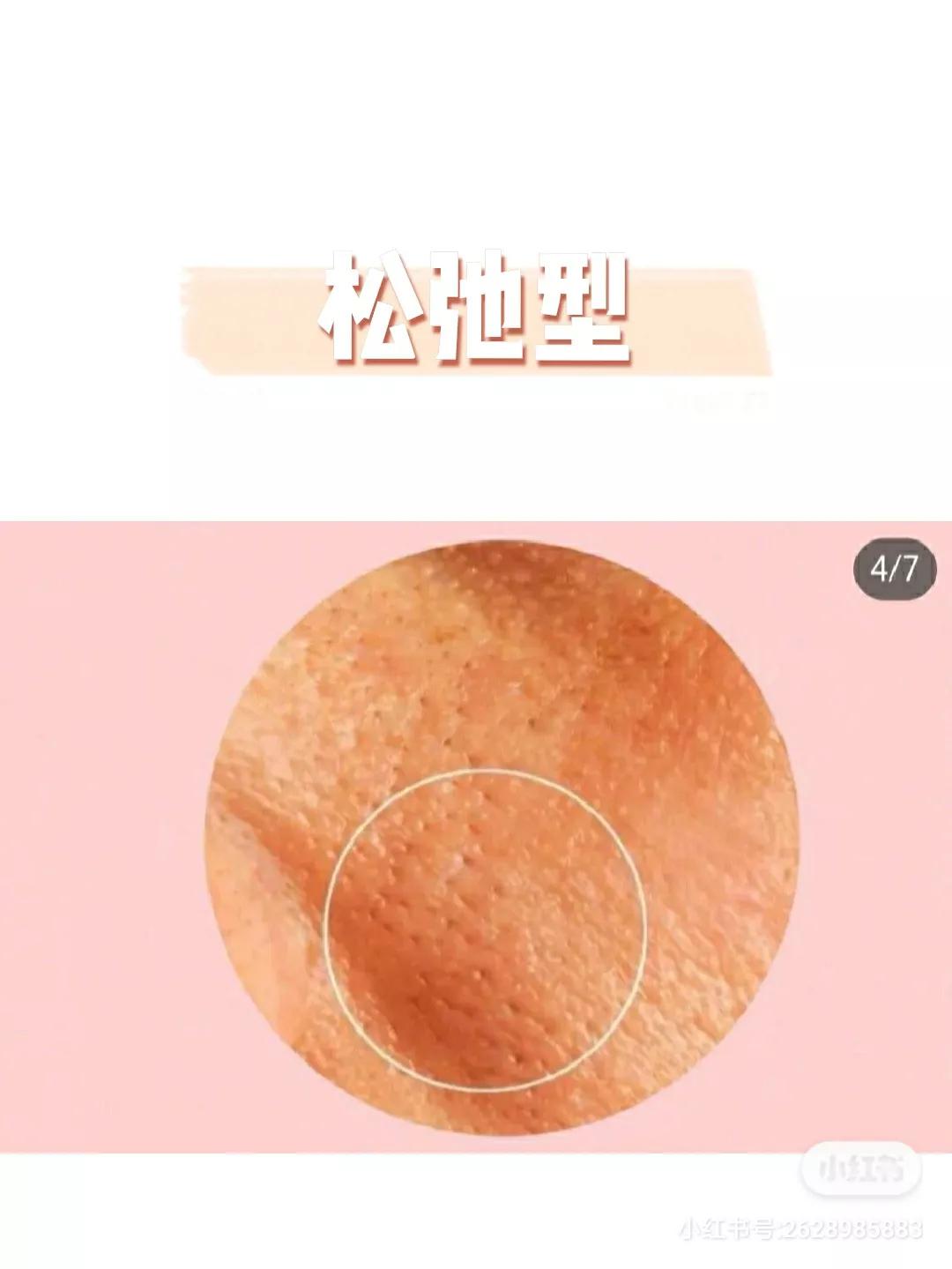 毛孔粗大全搞定这些知识要牢记,如何分辨毛孔粗大类型及改善毛孔