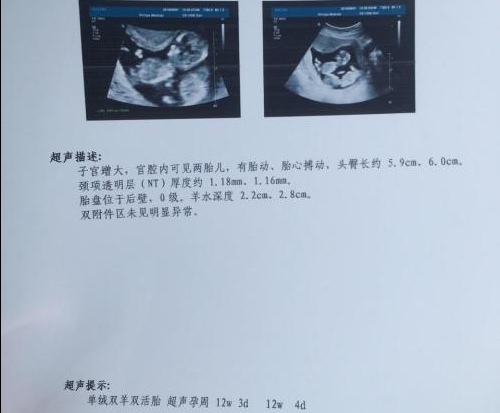 产检b超怎么看详细讲解,产检b超每次都查心脏