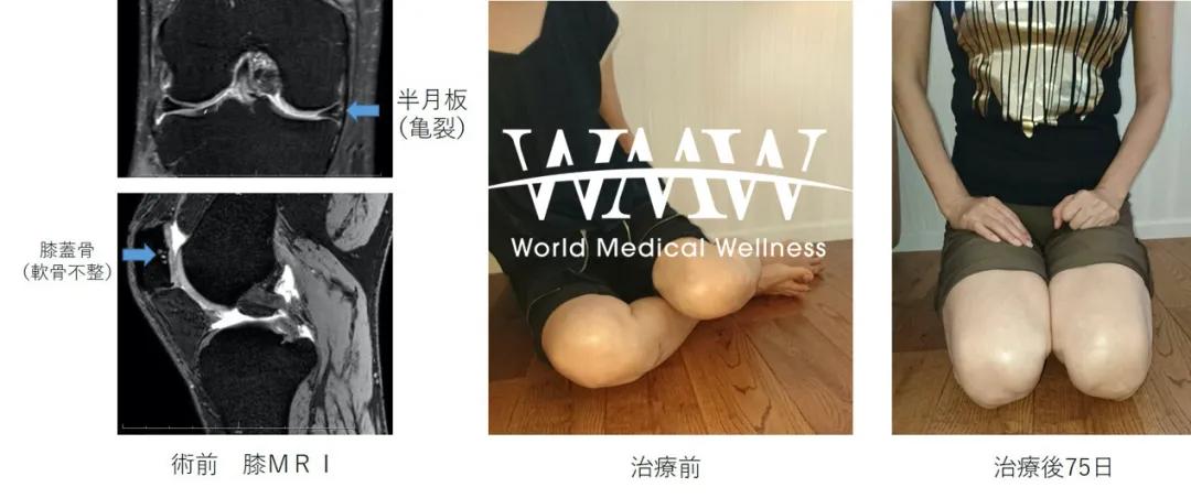 为什么干细胞成为治疗关节疼痛的最佳选择，来看看这些实例