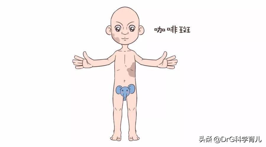 天生胎记黑毛痣会癌变会死吗,脖子上有个黑色胎记会癌变吗