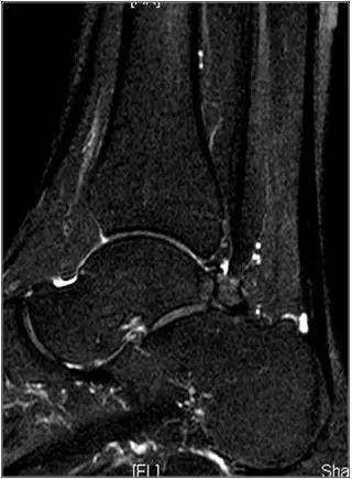 踝关节撞击症问诊,踝关节内侧撞击综合症位置图